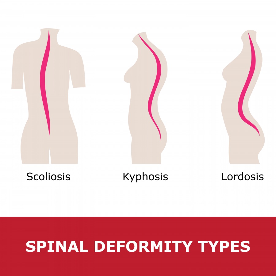 Image result for lordosis